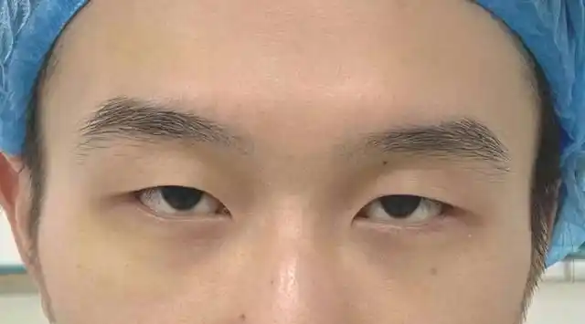 上睑下垂是上眼睑常见的一种问题,正常人的眼睛在平视前方的时候睑缘