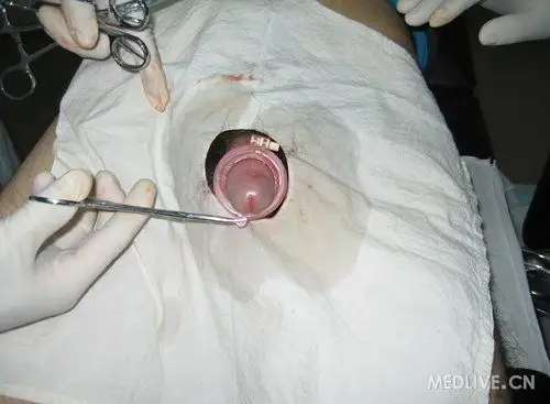 最新包皮环切图谱真实图片