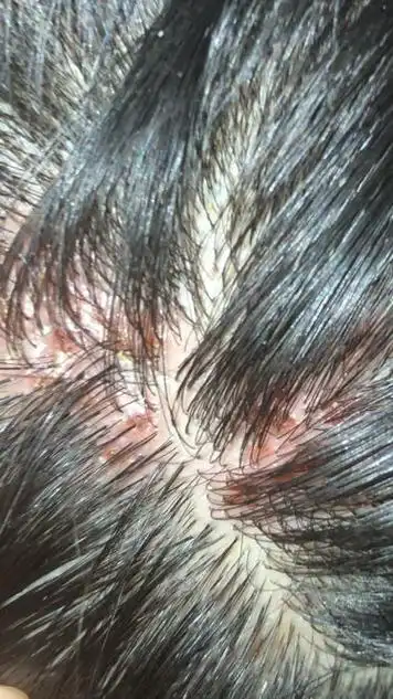 头皮有黑斑是怎么回事 - 搜狗图片搜索