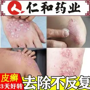 牛皮癣藓皮肤药癣膏皮癣药膏根除断根癣外用瘙痒草本苗草王癣痒净