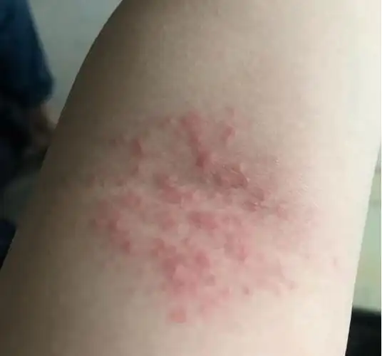 湿疹图片初期症状图片一般湿疹多久会消失