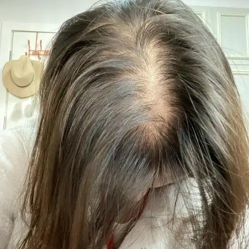 如何解决女生脱发? - 知乎