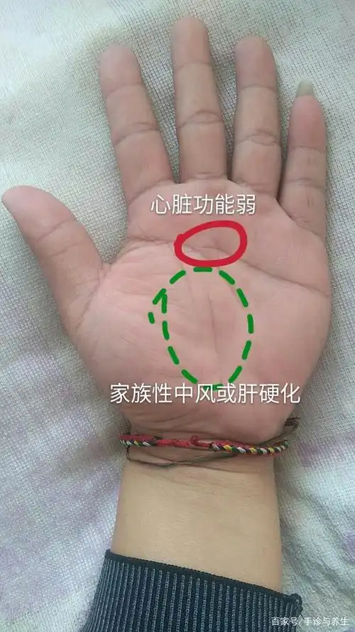 此掌纹为女性,生命线末端有像眼睛一样的小岛纹,提示的是子宫肌瘤的