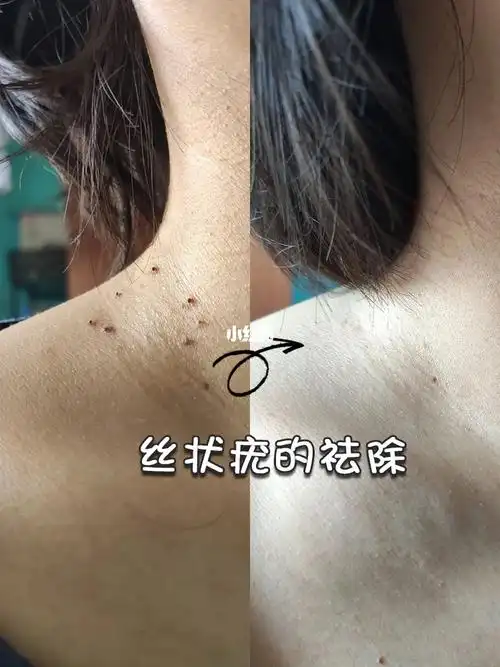 孕期丝状疣用对方法轻松祛除