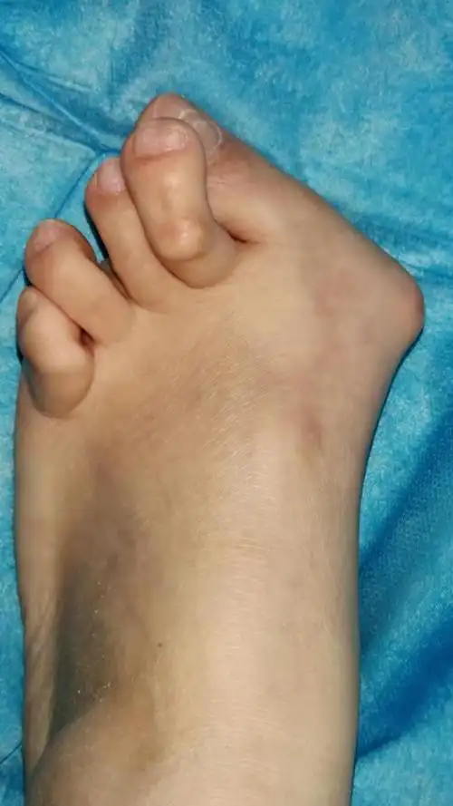 什么是拇外翻拇外翻不治疗可以吗