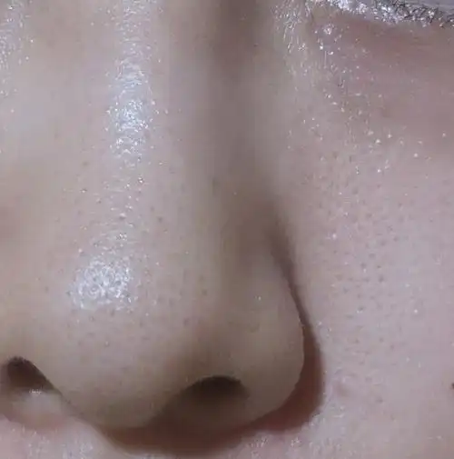 慎入…请问各位uu如何处理毛孔粗大 黑头