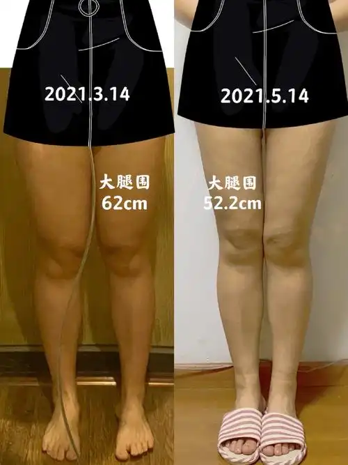 手术内容:黄金微雕大腿环吸 术前情况 身高:170cm 体重:70kg 大腿围度