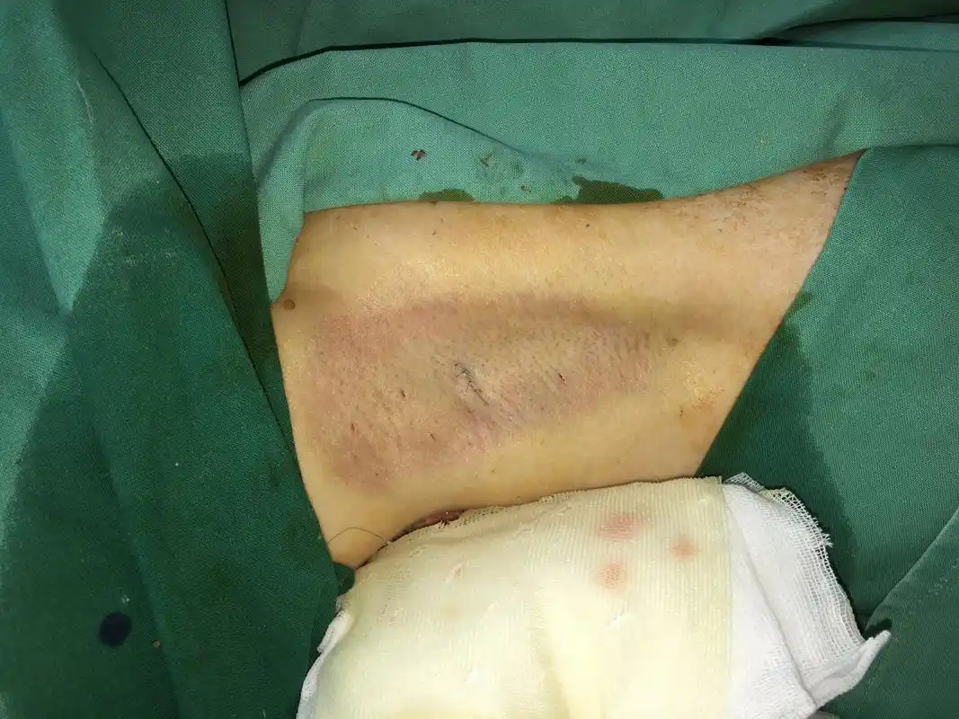 腋臭进行手术切除大汗腺可根治,手术应在青春期后做,会遗传