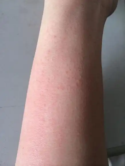 身上出现皮肤过敏的症状怎么办_大全-幸福起航