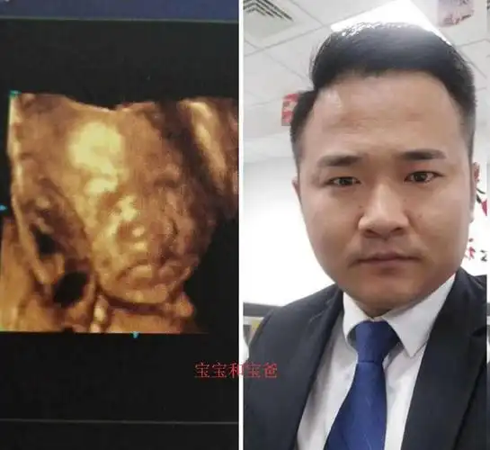 四维彩超宝宝鼻子大知道四个原因孕妈可以安心了