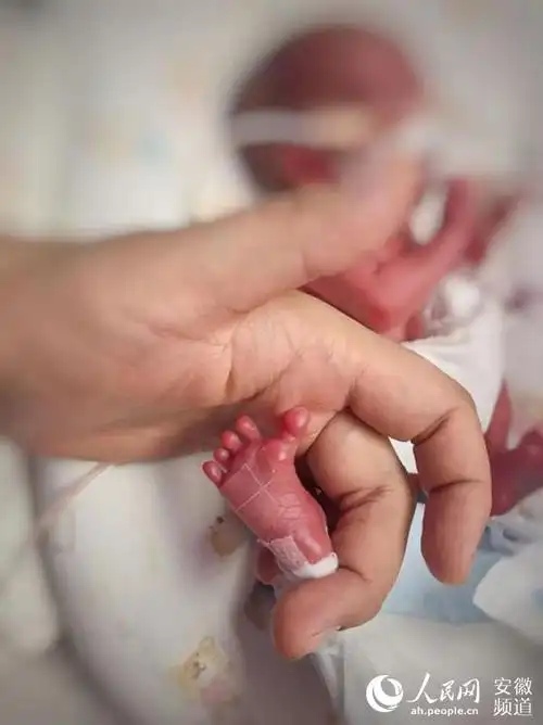 中国科大附一院成功救治一名580克极早早产儿