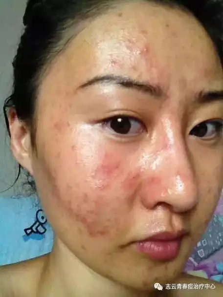 女孩子脸上长痘的五种原因和解决方案