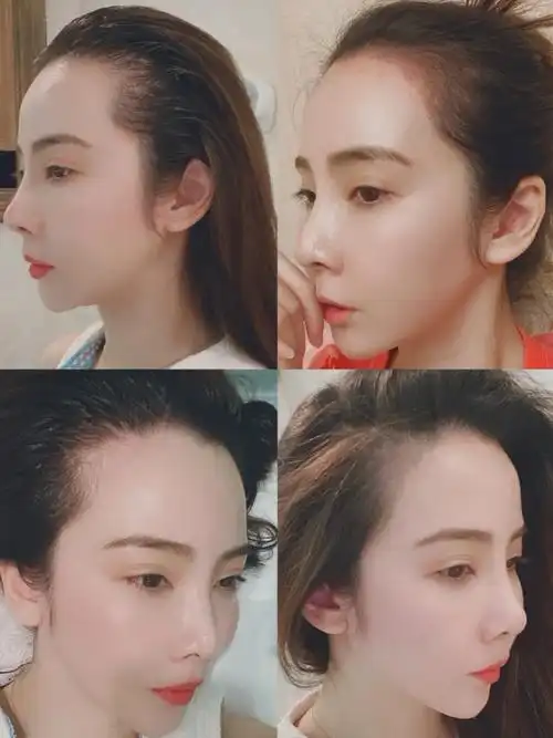 发际线如果太高的话,我觉得纹发际线是最好的选择,而_圈子-新氧美容