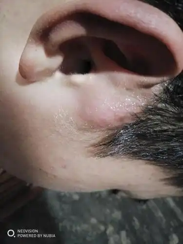 弟弟耳朵那里长了一个大包,会疼,不知道是怎么回事,担心