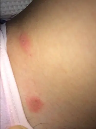 我身上分散这起了好几个像蚊子叮的疙瘩,不痛不痒,有几个快下去的摸