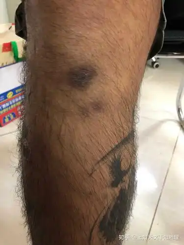 伤疤好了却变黑了