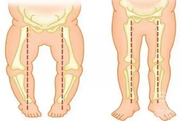 宝宝走路内八字怎么办 教你如何矫正