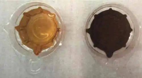 因为尿酸高,大量的尿酸盐结晶会堵塞在肾小管,肾盂及输尿管内,可引起