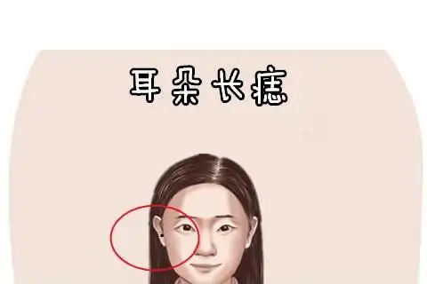 女人右耳垂有痣运势分析