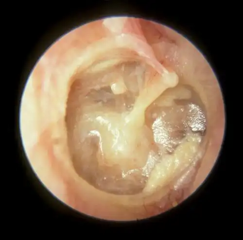 粘连性中耳炎怎么治疗