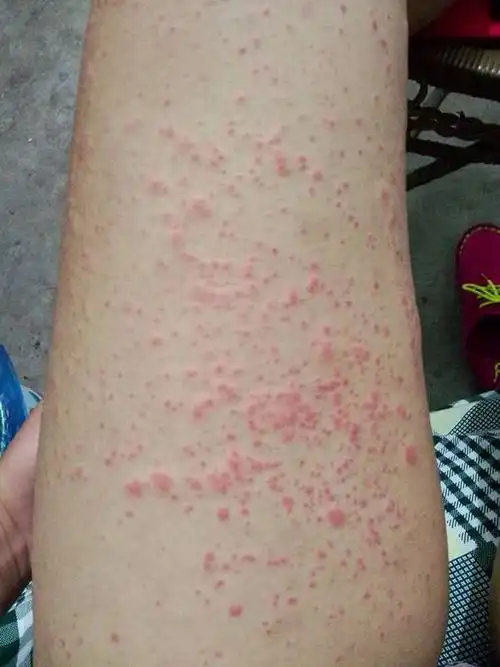 腿上长大片红点,痒,这是什么症状?