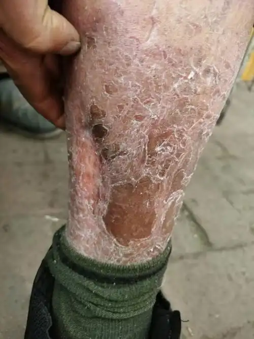 糖尿病性溃疡伴窦道形成患者,患者为老年男性,入院半月前患小腿部有一