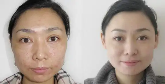 面部提拉前后对比真人实例