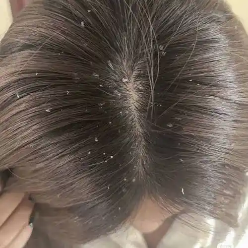 头屑多用什么洗发水最好?洗发水去屑品牌排行榜前十名