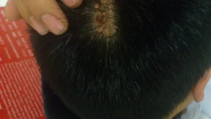 头上长个跟好多肉包似的的东西 好多年了 有图片 想知道叫什么?