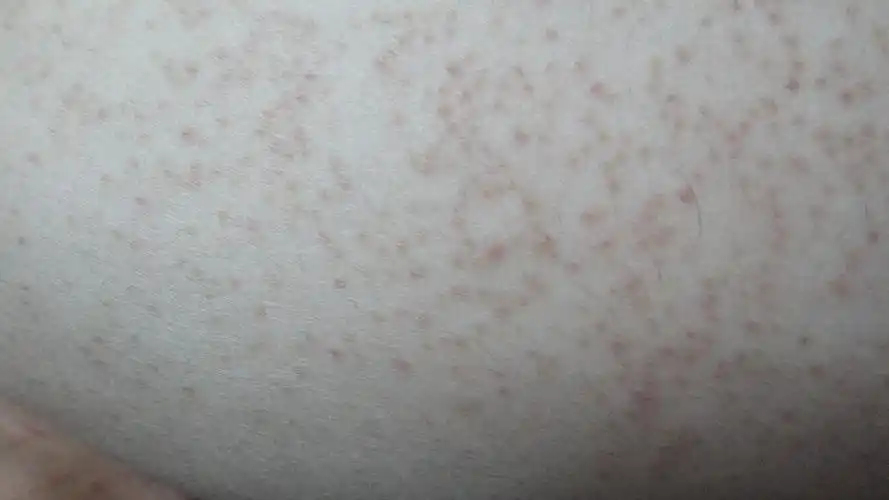 很多年了,不知道怎么得的,不痛不痒,怎么办?