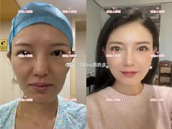 北京全脸填充##上海面部脂肪填充