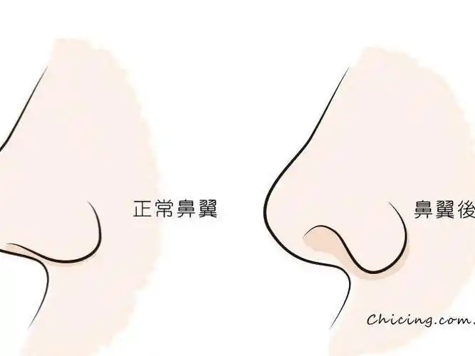 鼻翼的四种缺陷形态:鼻翼后缩,鼻翼下垂,鼻翼不对称_圈子-新氧美容