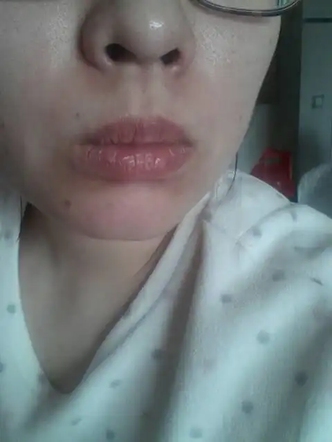 鼻子三角区和嘴巴下边皮肤颜色有变化,具体什么时候开始的不知道,只