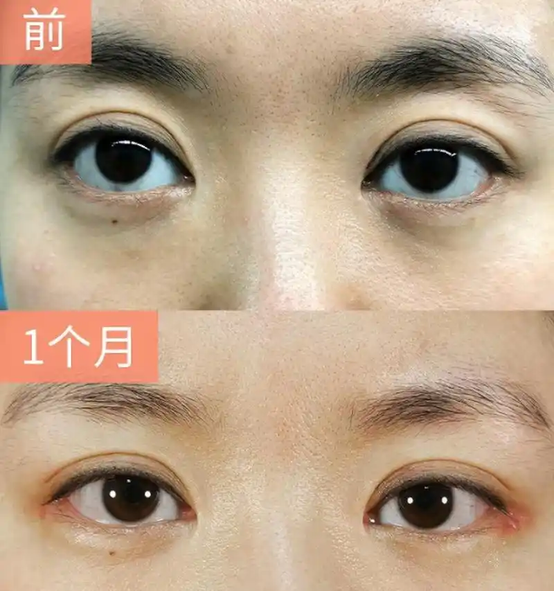 下图这位女患者下眼睑下垂,退缩,呈现三白眼,做完手术后眼神都变得