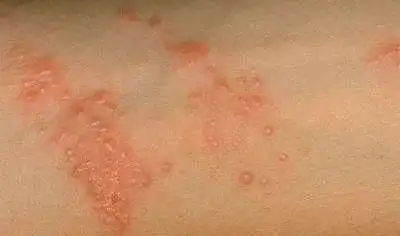 皮肤上有3种表现,十有八九是糖尿病,趁早检查,可防并发症