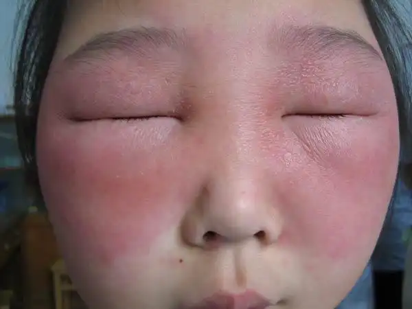 化妆品引起的皮肤病有哪些?医生告诉该怎么处理?