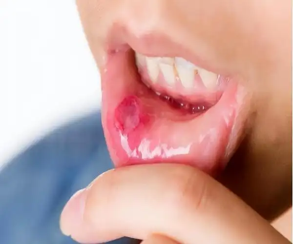 华素片 西地碘含片是治疗慢性咽炎,口腔溃疡的常用药,使用时应注意4点