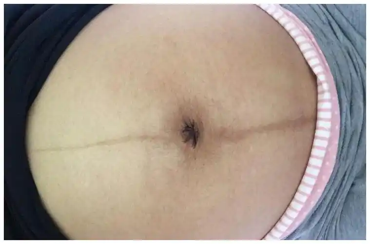 如果孕妈的肚脐是"凹进去"的状态,说明胎儿发育很好|肚脐|怀孕|孕妇