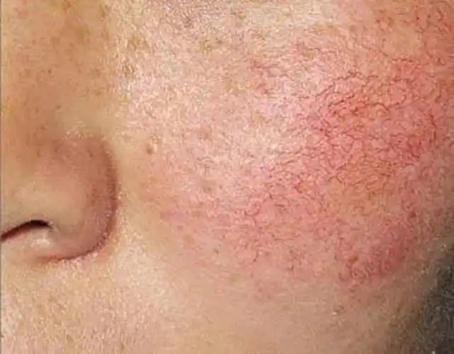 红血丝,"性感"的红脸蛋.