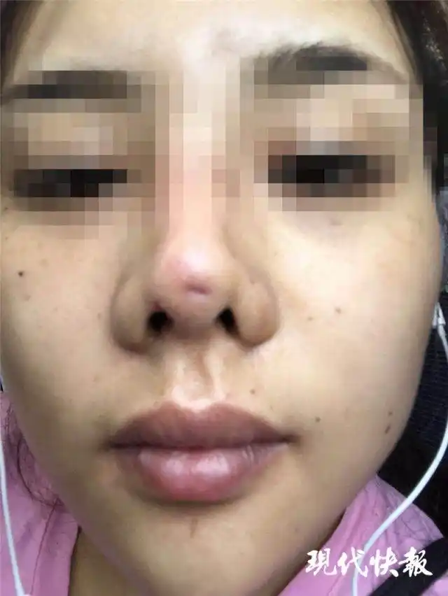 南京怡华医疗美容医院整形失败 90后姑娘隆鼻后成了"猪鼻子"