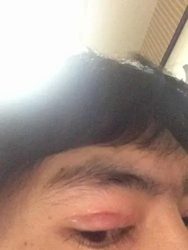 上眼睑红肿痒水泡,平均2到3天出现一次,反复的出现,大约出现一次2到3