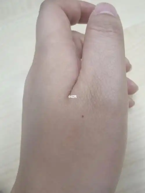 听说左手痣是有一个很爱你的人