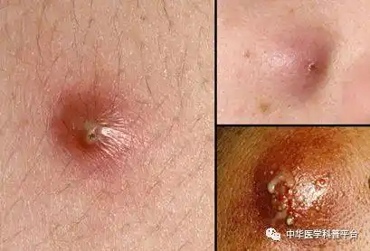 不做"包"大人——谈谈"疖"