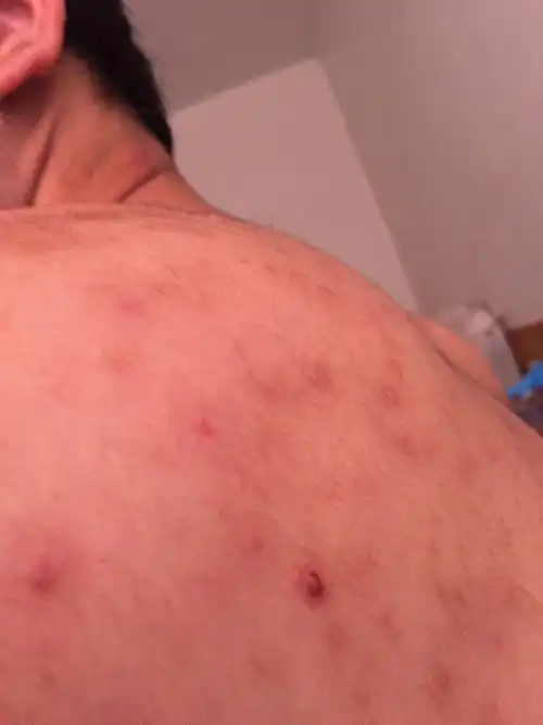 背上长了很多的痘痘有2年多了记得2014年的56月份的