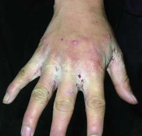 疥疮图片和症状图片女 - 搜狗图片搜索