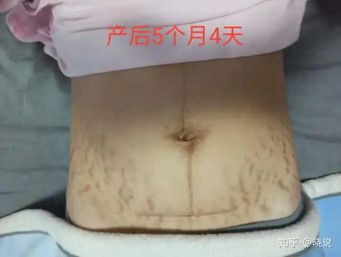 女人生完孩子后肚子的真实状态是怎样的?