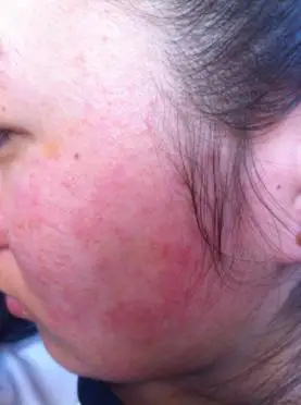 皮肤敏感红肿瘙痒的对策是什么