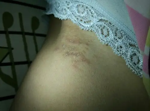 女,23,一个星期前开始发现大腿内侧痒,就挠,越挠越扩散,现在是这个