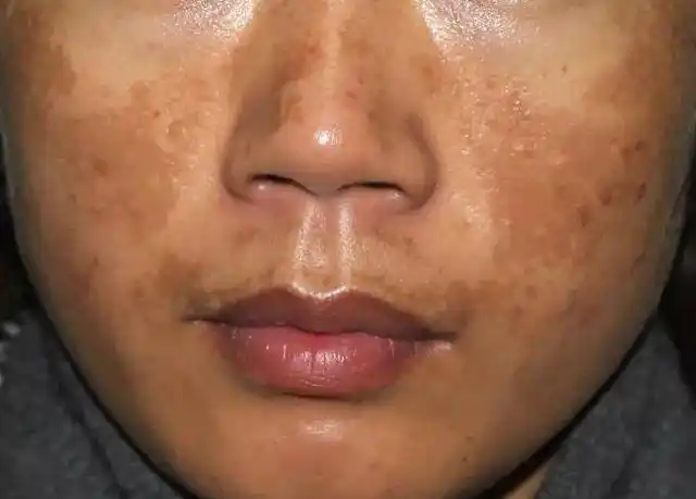 黄褐斑为什么难治?_商进_副主任医师_爱问健康