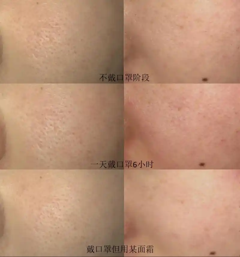 一天6小时戴口罩会造成毛孔粗大